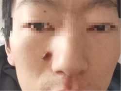 -痣斑堂·取大痣