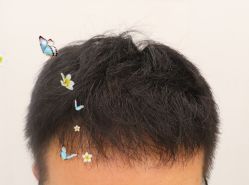 -大麦微针植发全国连锁