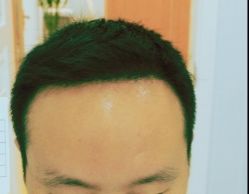 -大麦微针植发丨全国连锁