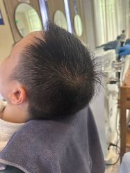 -大麦微针植发丨全国连锁