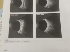 -成都新视界眼科医院·近视手术·儿童近视