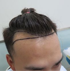体验前-碧莲盛·不剃发植发