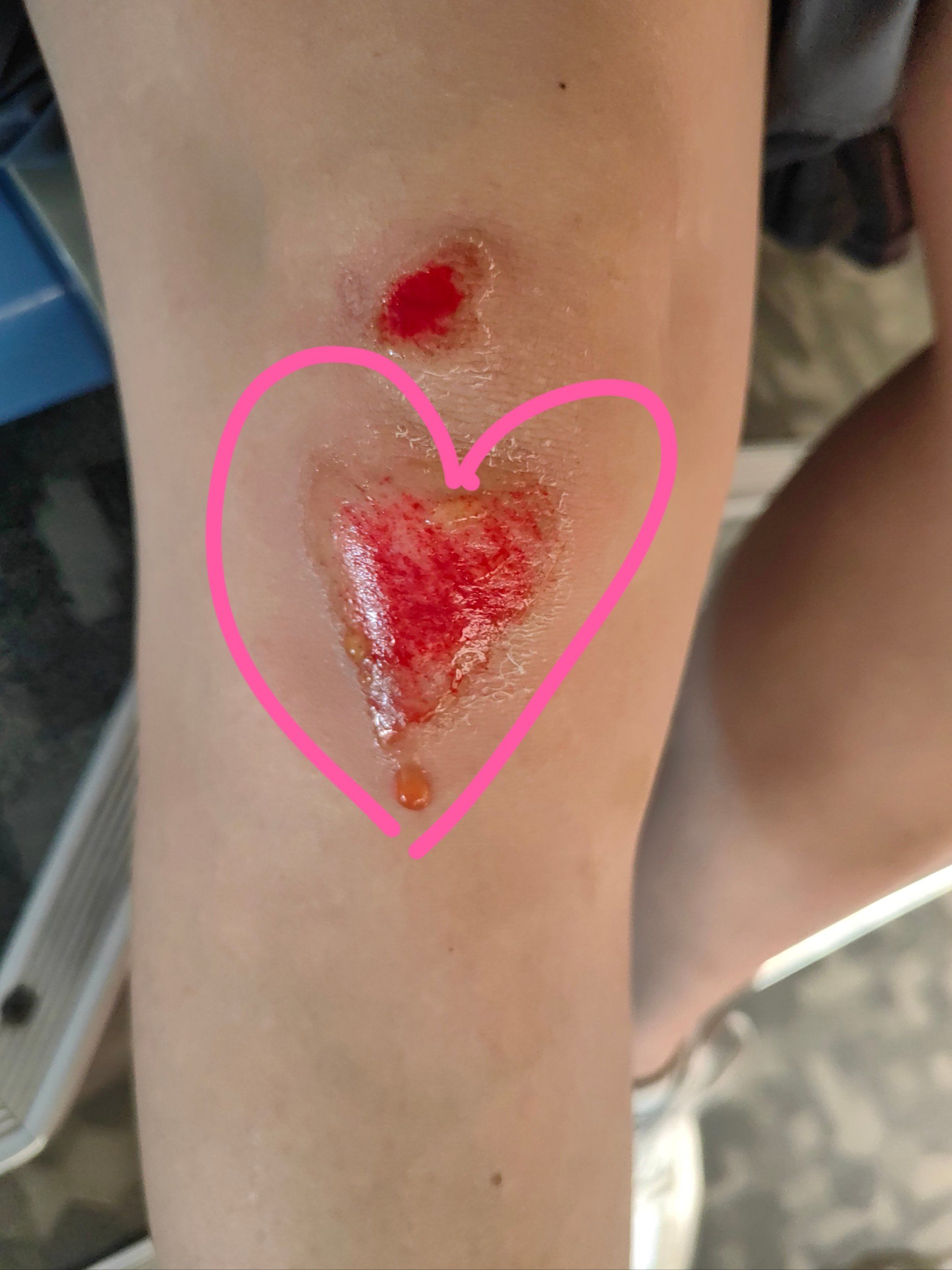 记录打工人的受伤状态