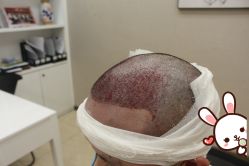 -大麦微针植发丨全国连锁