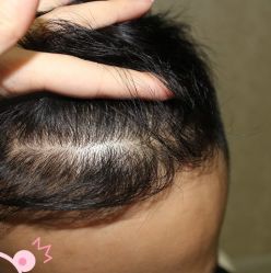 -大麦微针植发丨全国连锁