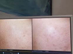 点击看大图 -苑苑vbeauty科技美容SPA
