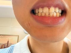 -上海仁爱医院口腔科 · 种植