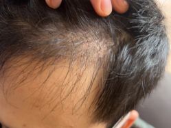 -碧莲盛·不剃发植发