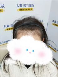 -大麦微针植发丨全国连锁