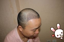 -大麦微针植发丨全国连锁