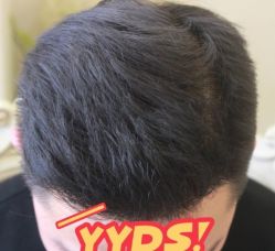 -大麦微针植发丨全国连锁