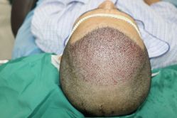 -大麦微针植发丨全国连锁