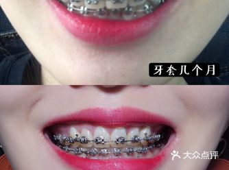 牙套两年多，你想知道的都在里面！