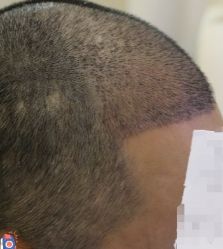 -大麦微针植发丨全国连锁