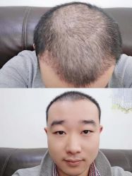 -雍禾植发全国连锁