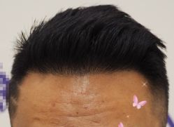 -大麦微针植发全国连锁