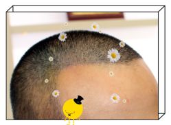 -大麦微针植发全国连锁