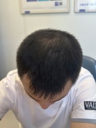 体验后-大麦微针植发全国连锁