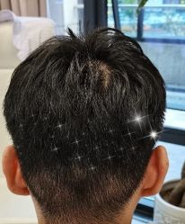 -大麦微针植发全国连锁