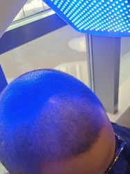 -碧莲盛·不剃发植发