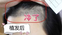 -大麦微针植发全国连锁