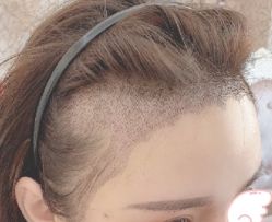 -大麦微针植发丨全国连锁