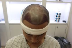 -大麦微针植发丨全国连锁