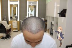 -大麦微针植发丨全国连锁