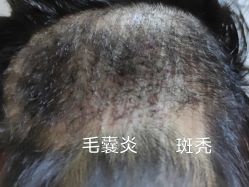 -新生植发·植养护一体