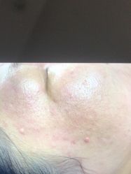 体验前-爱莎扁平疣·汗管瘤·斑痣中心