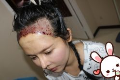 -大麦微针植发丨全国连锁