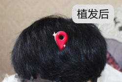 -大麦微针植发全国连锁