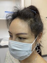 体验后-大麦微针植发全国连锁