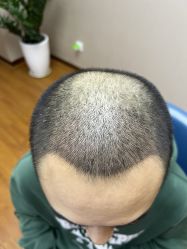 体验后-大麦微针植发全国连锁