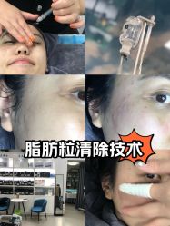-北京豆豆博士专业祛痘