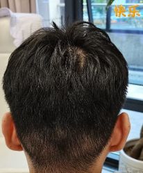 -大麦微针植发丨全国连锁