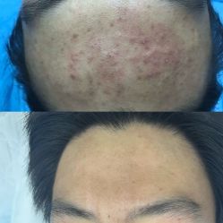 -蕾特恩专业祛痘国际连锁