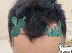 -大麦微针植发全国连锁