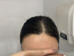 -大麦微针植发全国连锁