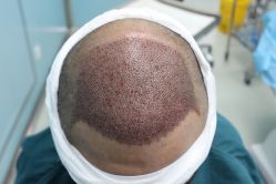 点击看大图 -大麦微针植发丨全国连锁