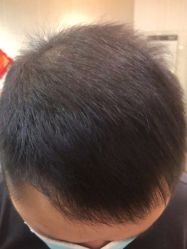点击看大图 体验后-新生植发·植养护一体