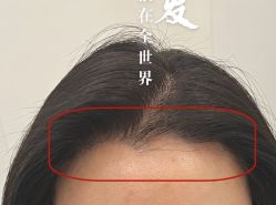 -大麦微针植发全国连锁