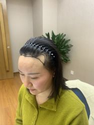 -大麦微针植发全国连锁