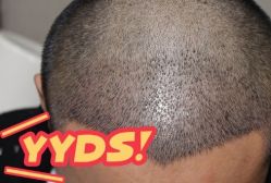 -大麦微针植发丨全国连锁