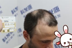 -大麦微针植发丨全国连锁