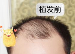 -大麦微针植发全国连锁