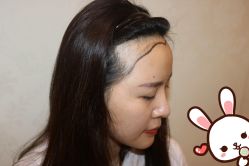 点击看大图 -大麦微针植发丨全国连锁