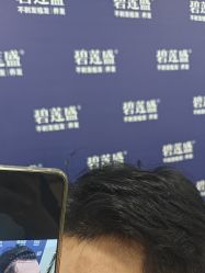 -碧莲盛·不剃发植发