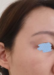 体验后-海涛医疗美容·面部抗衰·注射美鼻