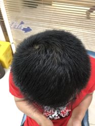 体验后-大麦微针植发丨全国连锁